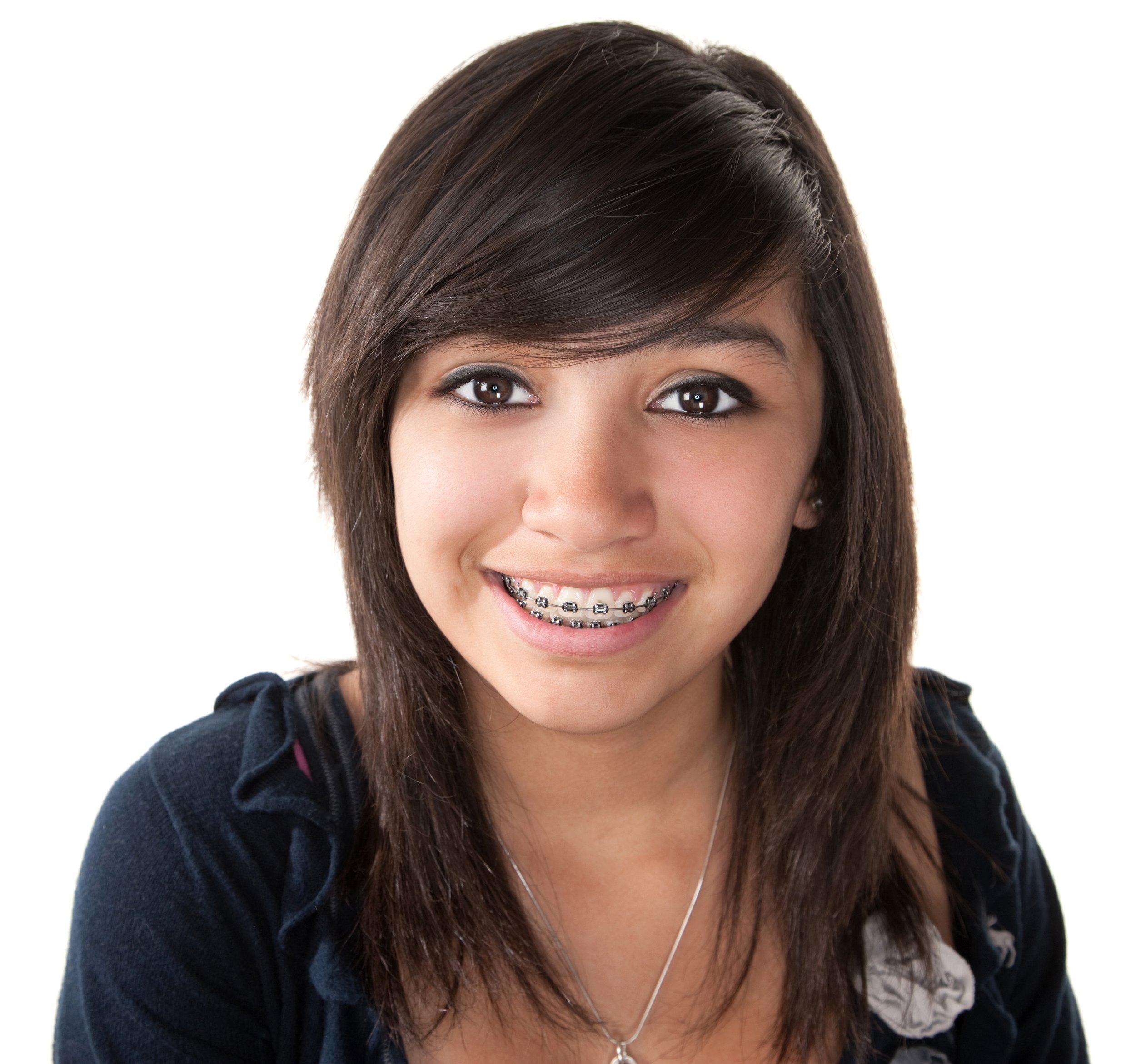 Dental Braces in teens and adults, Orthodontic treatment.