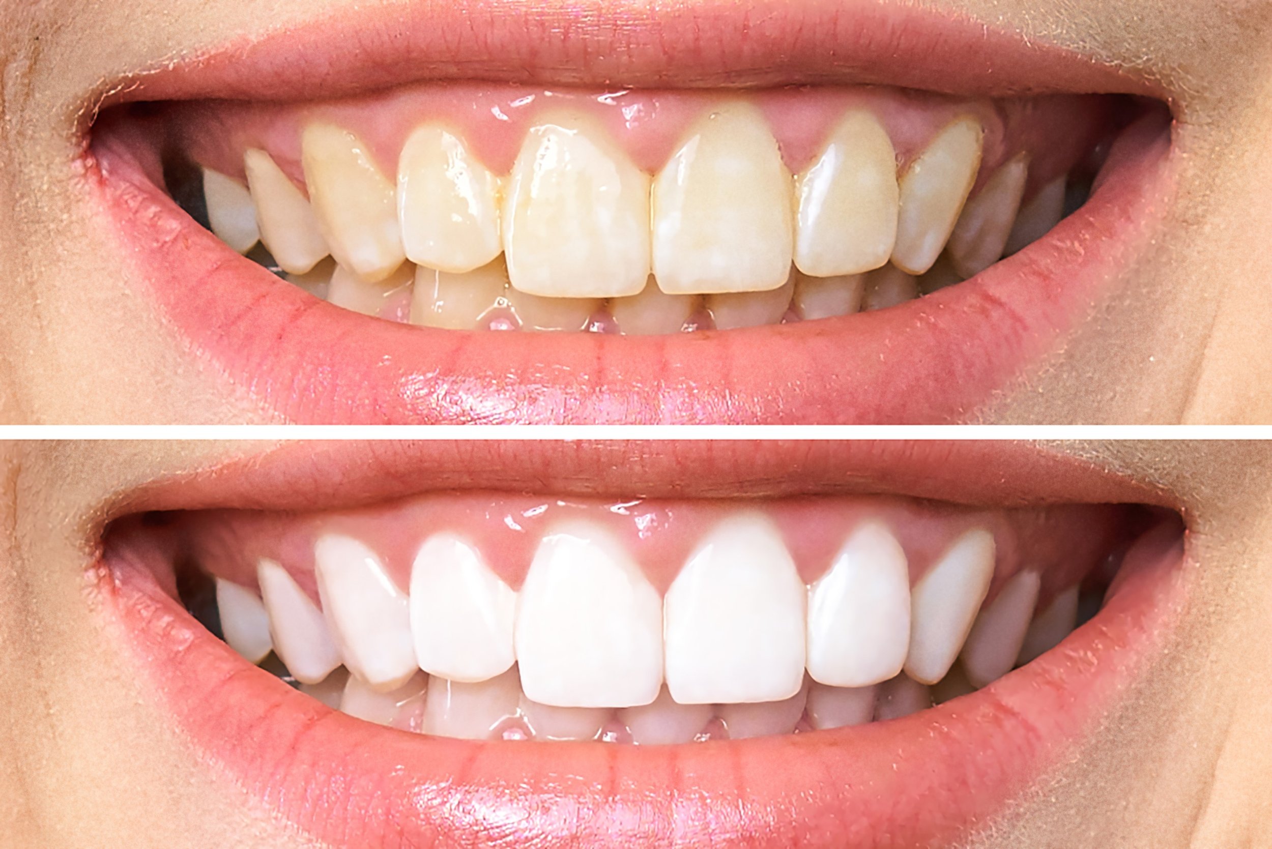 Professional tooth whitening with Popular Pola Tooth whitening system